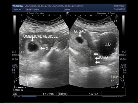 Ectopic Pregnancy With Iud | Renew Physical Therapy