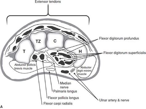 Wrist MRI | Radiology Key