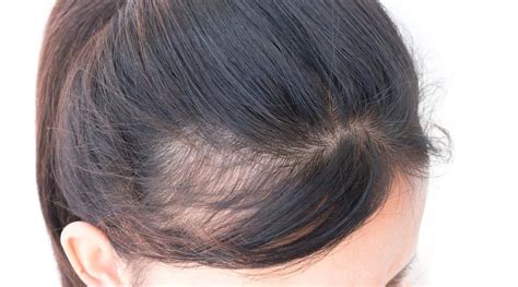 Frontal fibrosing alopecia from rare to frequent