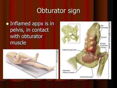 PPT - Appendicitis PowerPoint Presentation, free download - ID:6769039