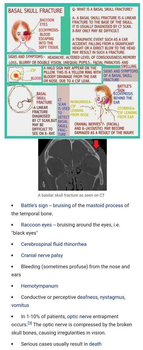 Basilar Skull Fracture Signs