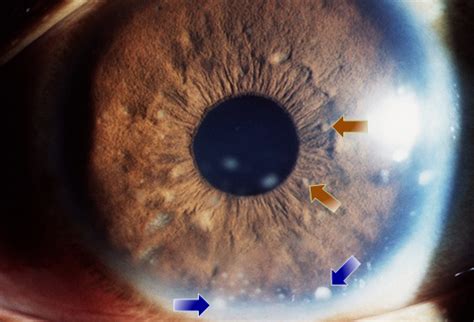 Syphilis Eye Infections Are Reported in L.A. County - WEHOville