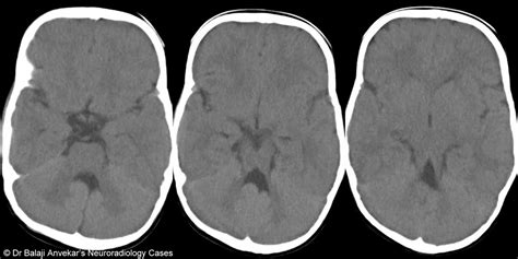 Dr Balaji Anvekar FRCR: Joubert Syndrome CT Brain