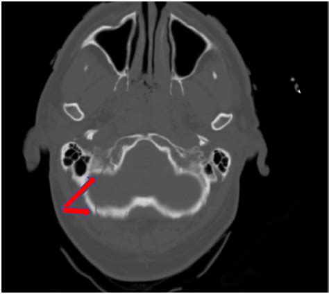 Initial non-contrasted CT brain, showing the basilar skull fracture ...