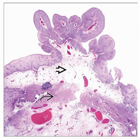 Squamous Papilloma | Basicmedical Key