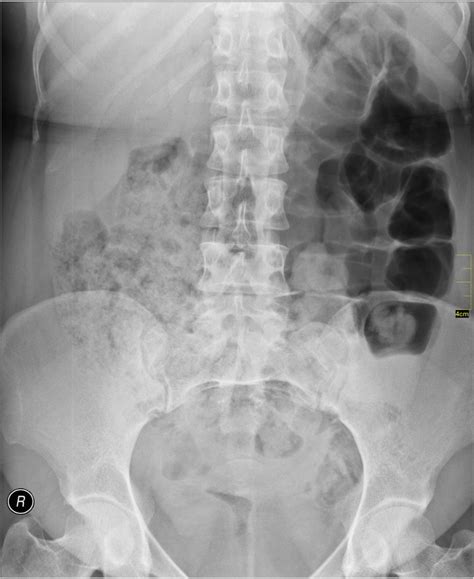 Gas Pain Lower Front Abdomen at Guillermo Mcclure blog