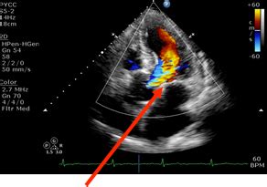 2D Echo/Doppler Study (2-Dimenstional Echocardiography/Doppler study) - Peter Yan Cardiology Clinic