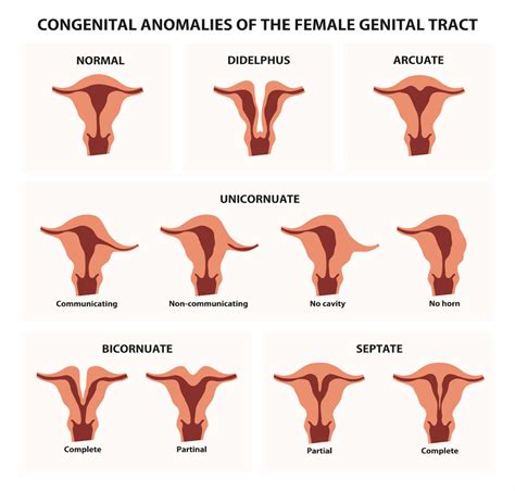 Unicornuate Uterus Treatment, Causes & its Type | Birla Fertility & IVF