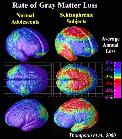 Schizophrenia.com - Schizophrenia Fact and Schizophrenia Statistics