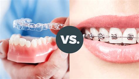 Differences Between Aligners and Braces - Vistadent