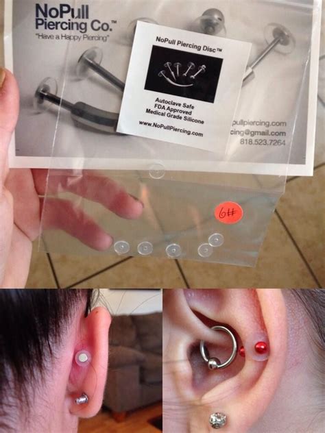 Hypertrophic Scarring Piercing Removal