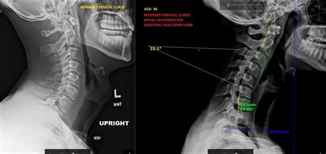 Correct Your Posture! - Thrive Spine Center