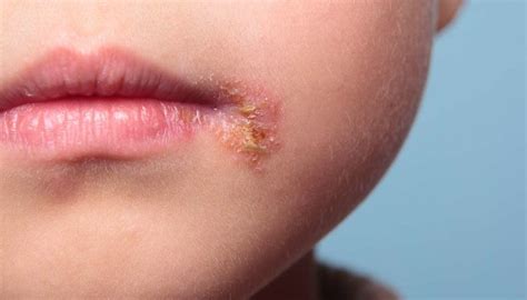 Can babies get cold sores? Causes, treatment, and risks