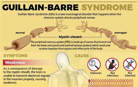 These are the symptoms of Guillain barre syndrome - MEDizzy