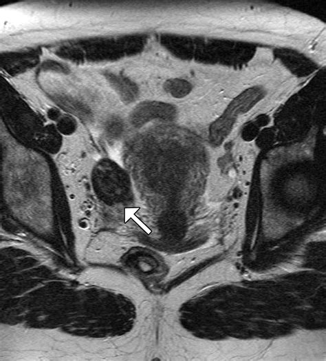 MR Imaging of the Sonographically Indeterminate Adnexal Mass | Radiology