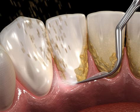 Periodontal Scaling & Root Planing | 3D Dentistry in Bradenton, FL