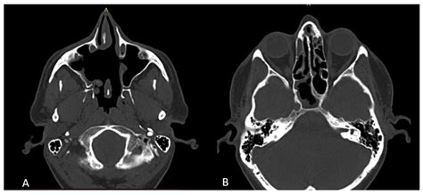 Surgeries | Free Full-Text | Endoscopic Excision of Rare Large Maxillary Sinus Osteoma: A Case ...