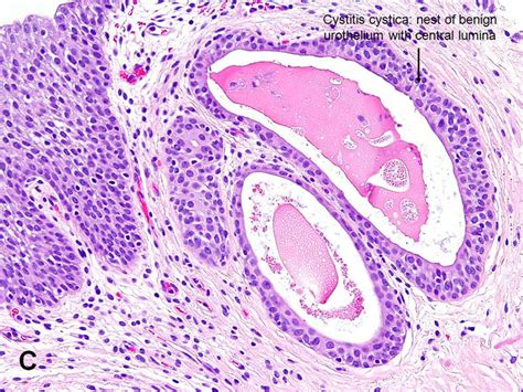 American Urological Association - Cystitis Cystica