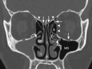 Sagittal Ethmoid Sinus