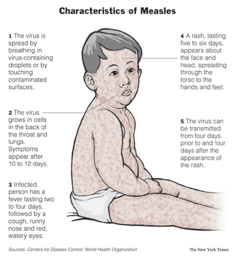 Free For Health: Measles - Causes-Symptoms and Treatment