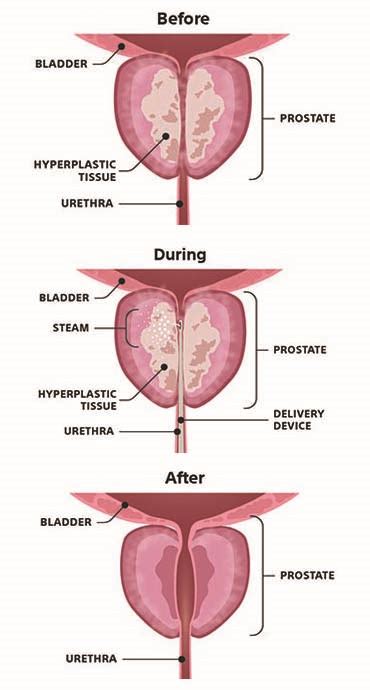 Rezūm™ Water Vapor Therapy for BPH - Gulfstream Urology Associates, P.A. - Dr. Adam Ball