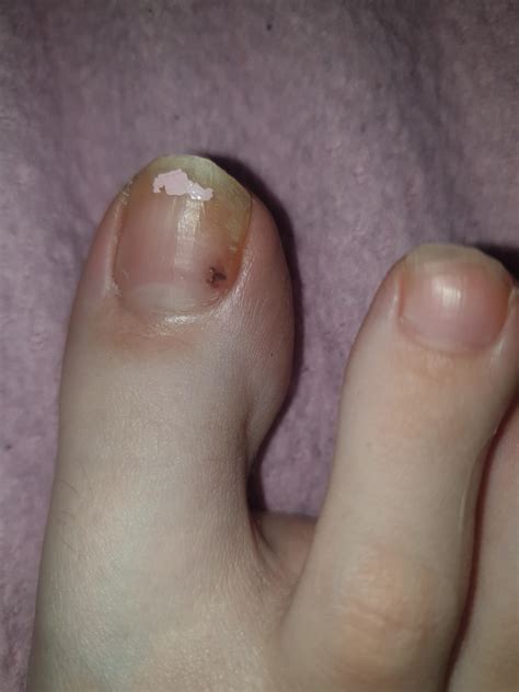 Black spot under toenail + pain and breaking nails. Appeared like 2 weeks ago. Should i be ...