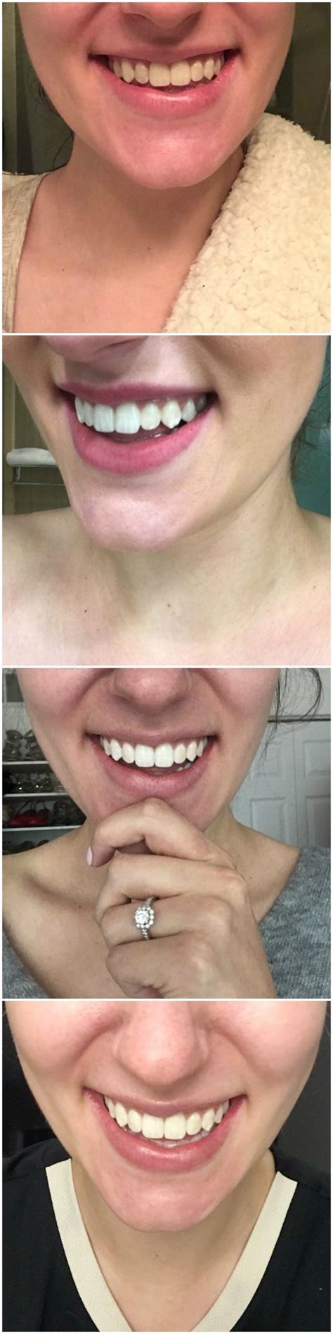 Crest 3D Whitestrips before And After | ipallshealthcare.com