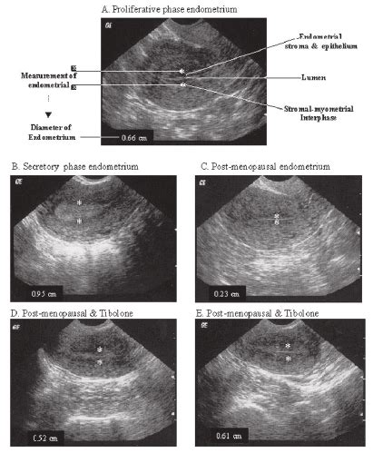 Proliferative Phase Endometrium