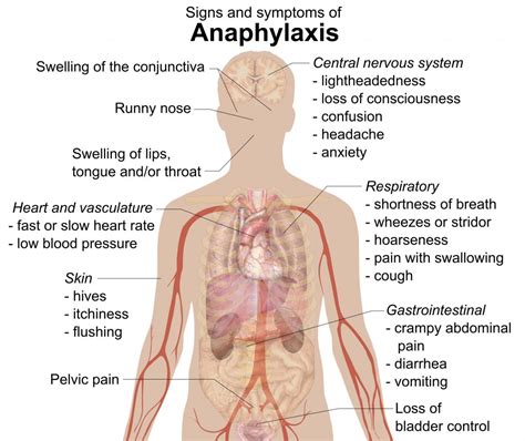 What Is Food Allergy? - ENT Florida