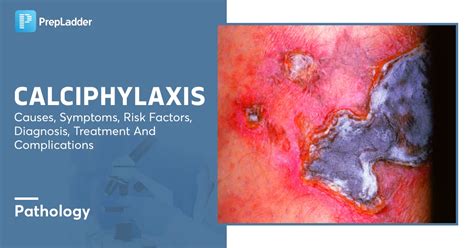 Calciphylaxis: Causes, Symptoms, Risk Factors, Diagnosis, Treatment and ...