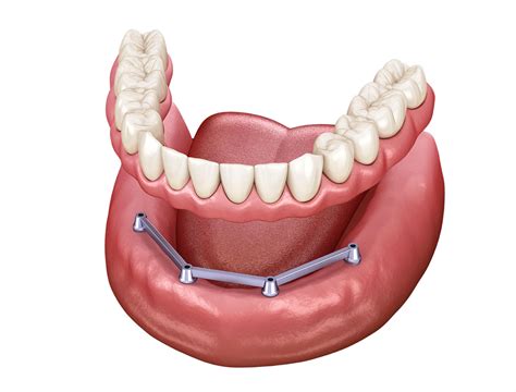 Removable Dental Implants - Artistic Dentistry