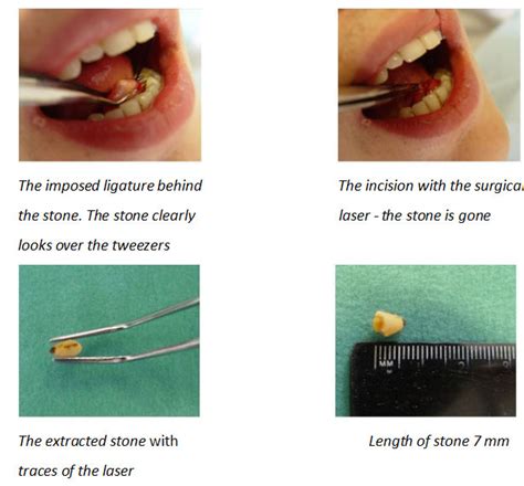 Salivary stone disease - www.multimplants.com