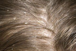 How To Get Rid Of Dandruff And Dry Scalp - Davis Facheneve