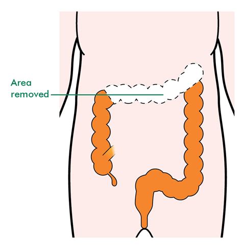 Types of surgery for colon cancer - Information and support - Macmillan ...