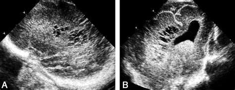 Posterior Fontanelle Sonography: An Acoustic Window into the Neonatal Brain | American Journal ...