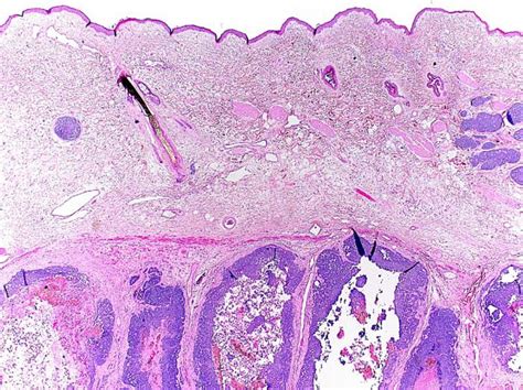 Private Skin Biopsy London - Skin Biopsy Procedure London