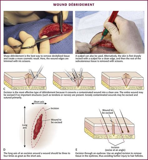 Principles of Wound Management | Veterian Key