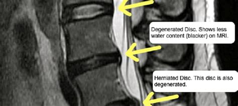 Lumbar Spine Mri Bulging Disc