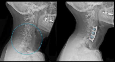 Degenerative Disc Disease | Cedars-Sinai