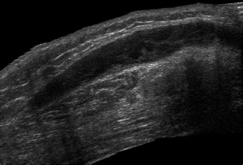 Imaging findings in Morel-Lavallée lesion | Eurorad