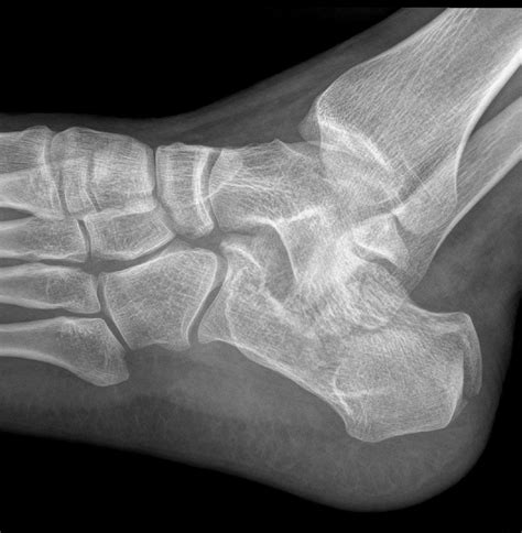 Calcaneus fracture | Image | Radiopaedia.org