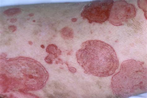 Narrow-Band UVB May Have Curative Potential for Mycosis Fungoides - Dermatology Advisor