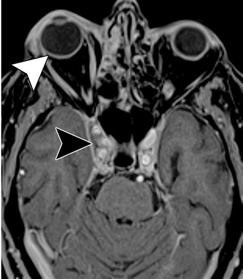 Imaging Spectrum of Cavernous Sinus Lesions with Histopathologic ...