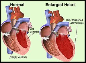 » Cardiomegaly – Causes, Treatment, Symptoms, Pictures, Types