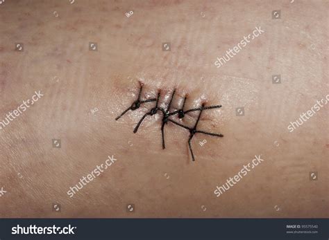 Closeup Picture Skin Wound Stitches Stock Photo 95575540 - Shutterstock