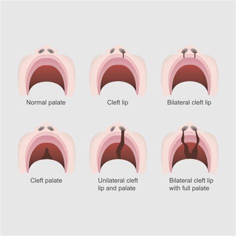 Cleft Lip & Palate Surgery in Houston, TX | Piney Point Oral & Maxillofacial Surgery