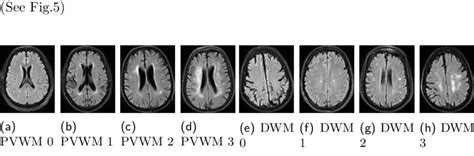 Fazekas scale for the DWM and PVWM lesions. Although the grade of the ...