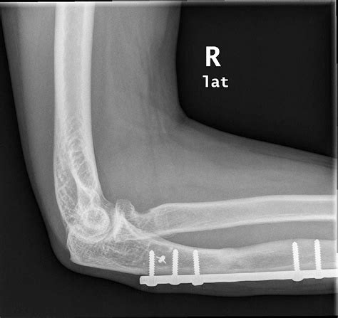 Cureus | Two-Year Outcome of Synthetic Annular Ligament Reconstruction in the Elbow: A Case Report