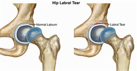 Hip Labral Tear: Sports Medicine Doctor Mesa AZ, Orthopedic Surgeon