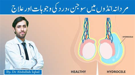 Testicular Pain and Testis Swelling | Hydrocele Causes, Symptoms & Treatment | Foton me dard ...